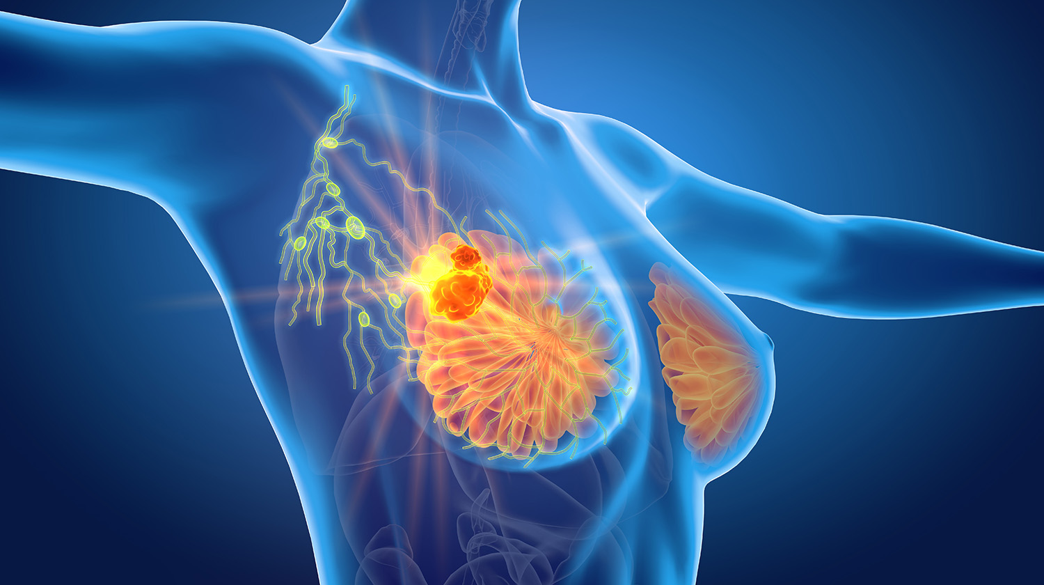 breast cancer