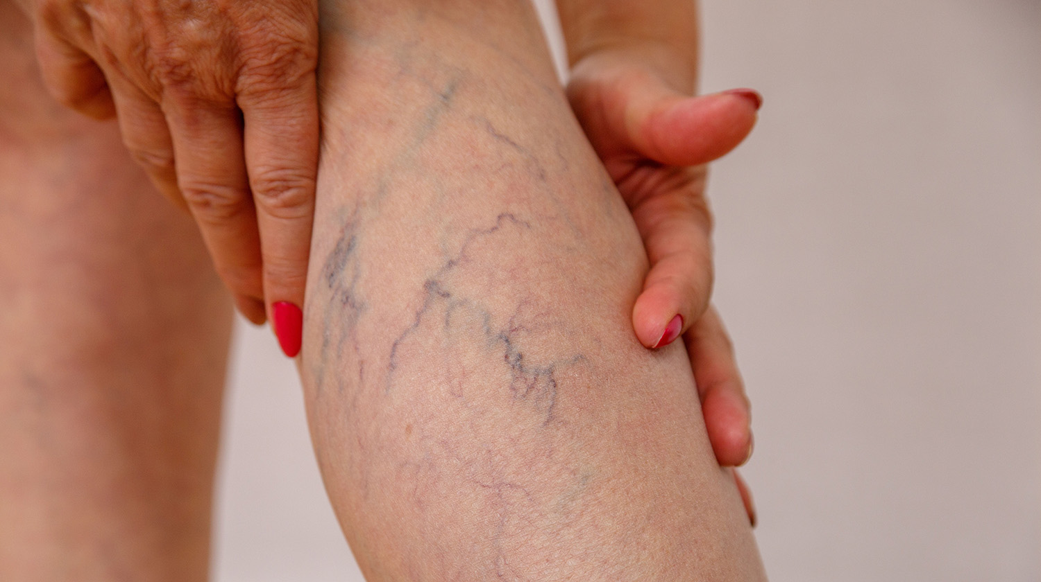 varicose veins on leg